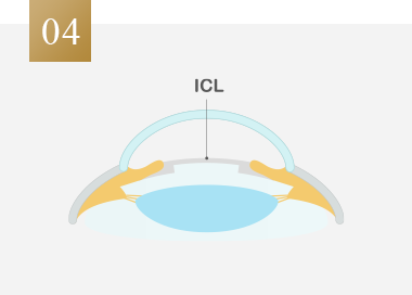 ICLを取り出せば元の眼の状態に戻せる