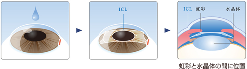 ICLの手術方法