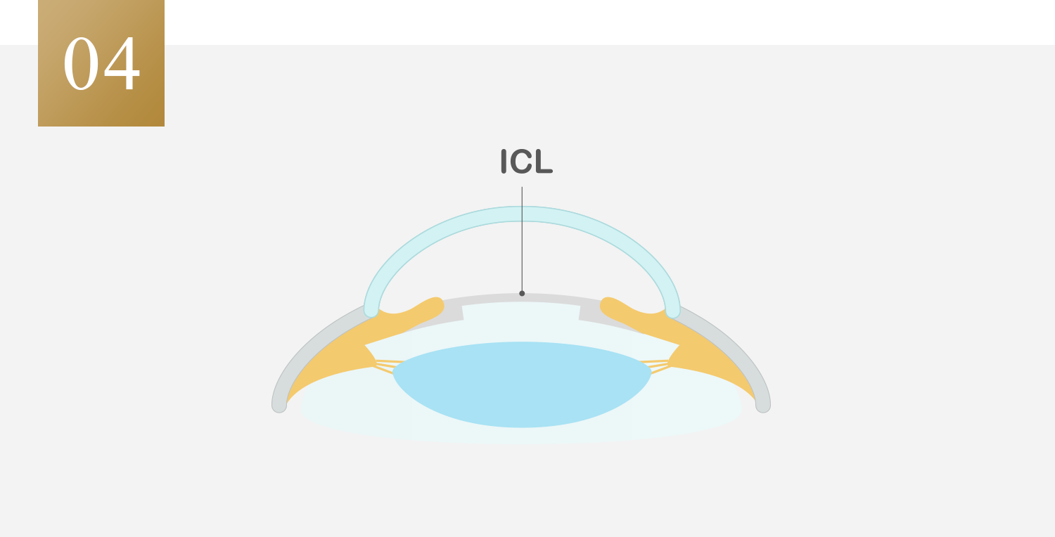 ICLを取り出せば元の眼の状態に戻せる